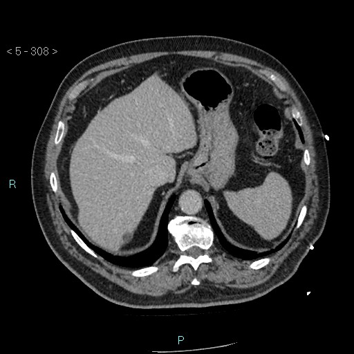 Aortic intramural hematoma (Radiopaedia 48463-53380 C 138).jpg