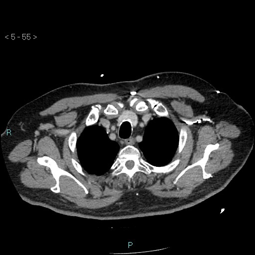 Aortic intramural hematoma (Radiopaedia 48463-53380 C 25).jpg
