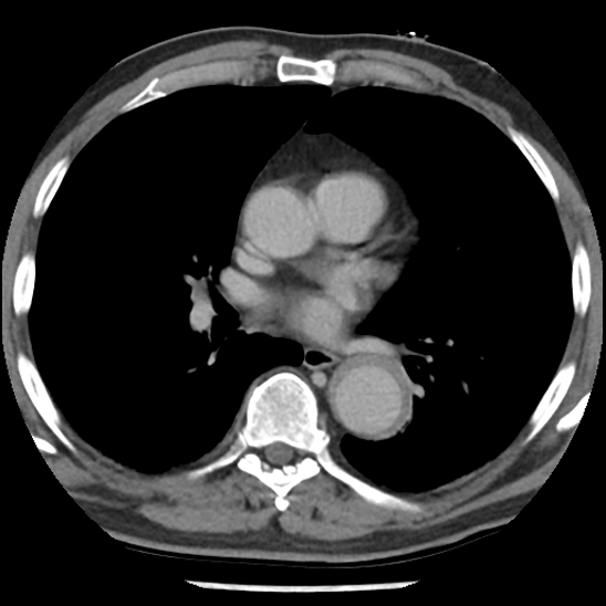 File:Aortic intramural hematoma (type B) (Radiopaedia 79323-92387 Axial C+ delayed 28).jpg