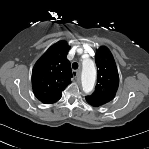 File:Aortic intramural hematoma from penetrating atherosclerotic ulcer (Radiopaedia 31137-31836 A 19).jpg