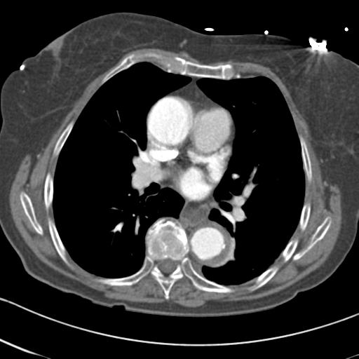 Aortic intramural hematoma from penetrating atherosclerotic ulcer (Radiopaedia 31137-31836 A 41).jpg