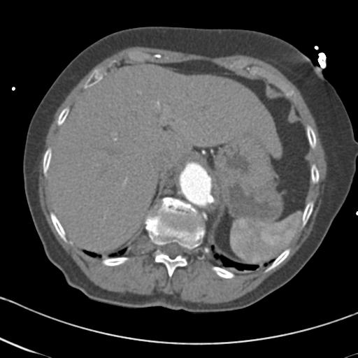 Aortic intramural hematoma from penetrating atherosclerotic ulcer (Radiopaedia 31137-31836 A 73).jpg
