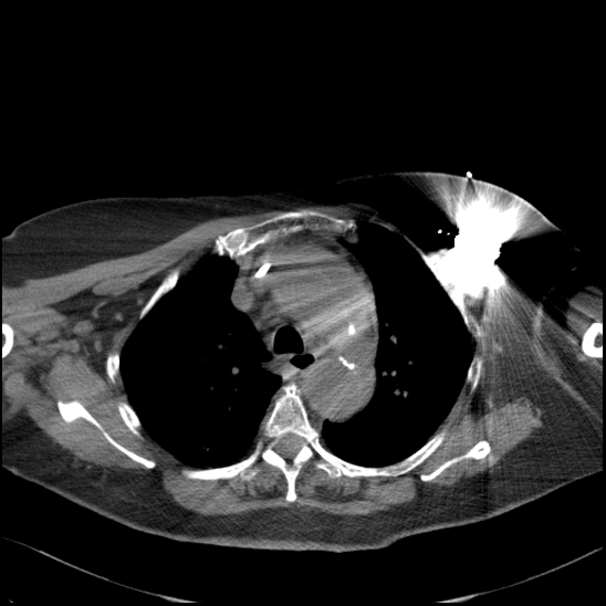 Aortic intramural hematoma with dissection and intramural blood pool (Radiopaedia 77373-89491 Axial non-contrast 30).jpg