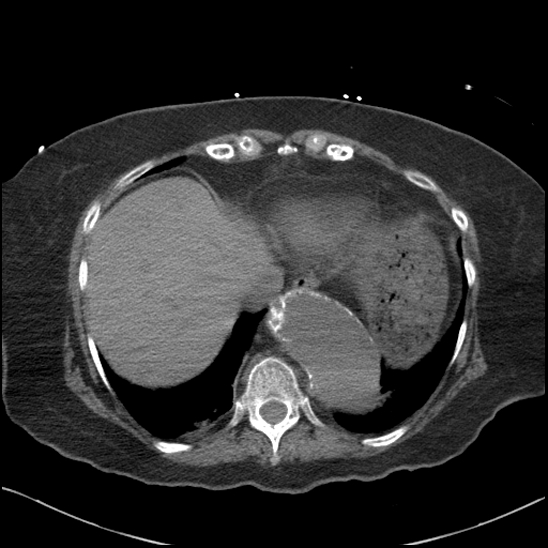 Aortic intramural hematoma with dissection and intramural blood pool (Radiopaedia 77373-89491 Axial non-contrast 79).jpg