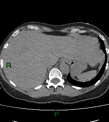 Aortic valve endocarditis (Radiopaedia 87209-103485 Axial non-contrast 87).jpg