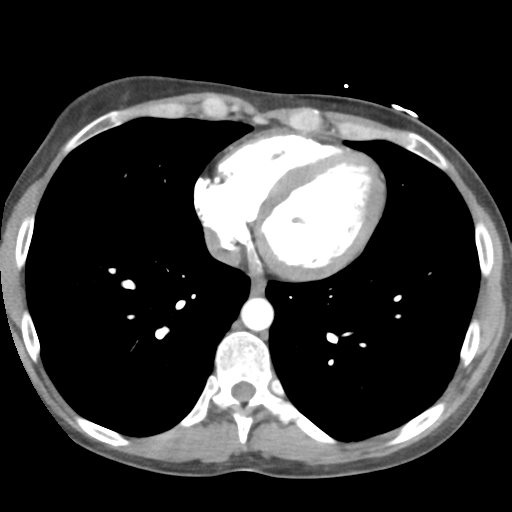 File:Aortic valve non-coronary cusp thrombus (Radiopaedia 55661-62189 B 35).png
