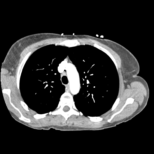 Aortic valve non-coronary cusp thrombus (Radiopaedia 55661-62189 C+ arterial phase 1).png