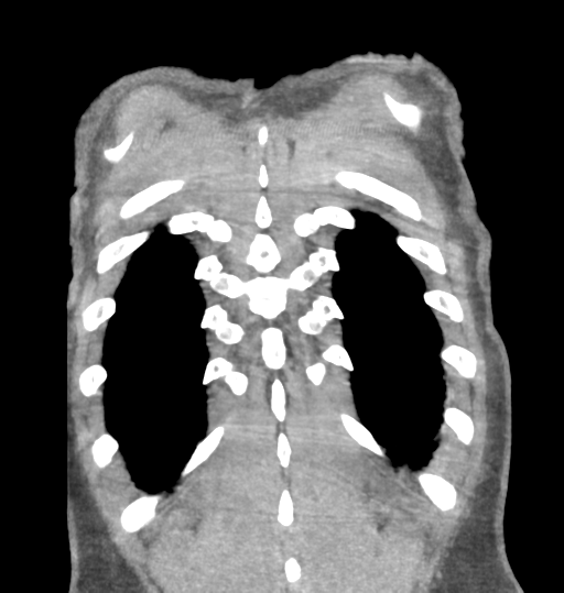 Aortic valve non-coronary cusp thrombus (Radiopaedia 55661-62189 C 72).png