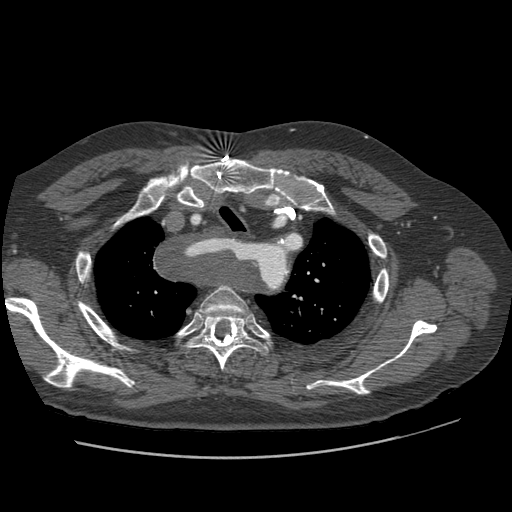 File:Aorto-coronary bypass graft aneurysms (Radiopaedia 40562-43157 A 24).png