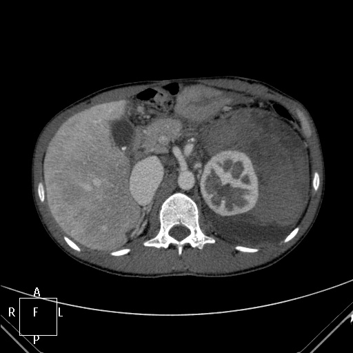 File:Aorto-left renal vein fistula (Radiopaedia 45534-49628 A 11).jpg