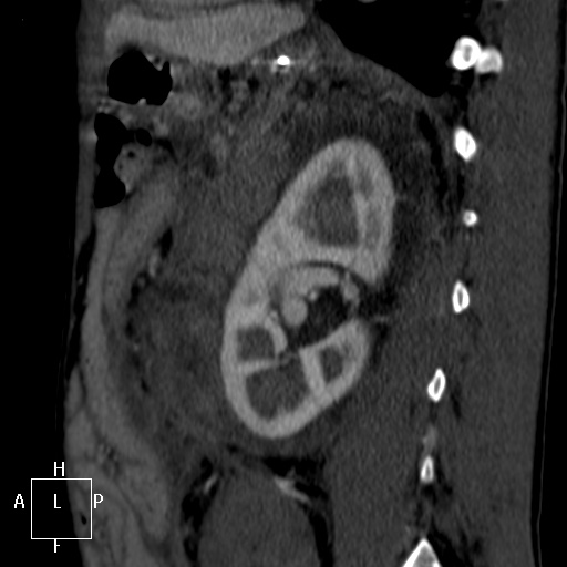 File:Aorto-left renal vein fistula (Radiopaedia 45534-49628 C 49).jpg