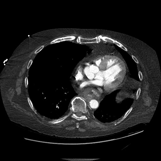 File:Aortoesophageal fistula with endovascular repair (Radiopaedia 73781-84592 Axial C+ CTPA 108).jpg