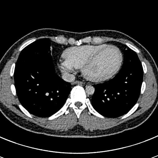 Apical lung mass mimic - neurogenic tumor (Radiopaedia 59918-67521 A 58).jpg