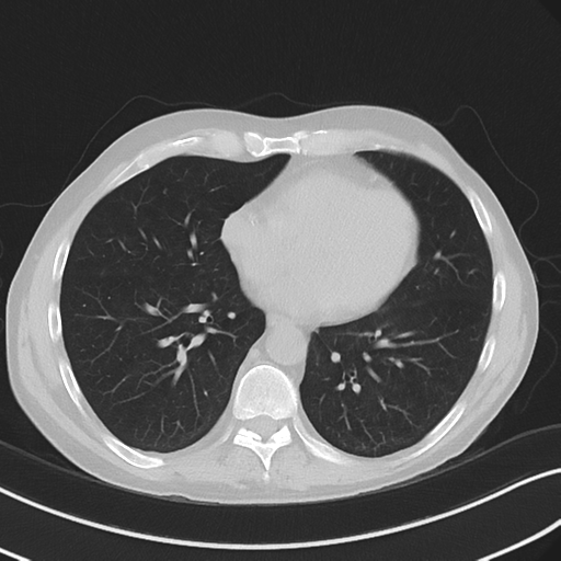 Apical pulmonary metastasis (Radiopaedia 46338-50754 Axial non-contrast 42).png