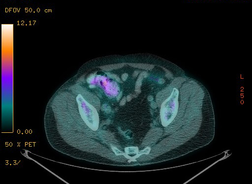Appendiceal adenocarcinoma complicated by retroperitoneal abscess (Radiopaedia 58007-65041 Axial PET-CT 173).jpg