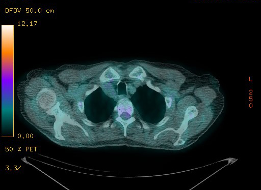 Appendiceal adenocarcinoma complicated by retroperitoneal abscess (Radiopaedia 58007-65041 Axial PET-CT 38).jpg