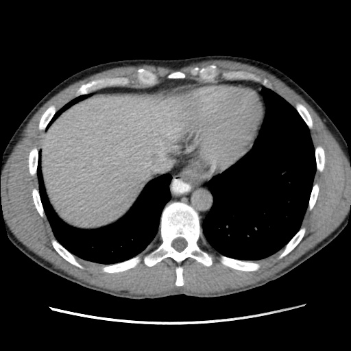 Appendicitis complicated by post-operative collection (Radiopaedia 35595-37114 A 11).jpg