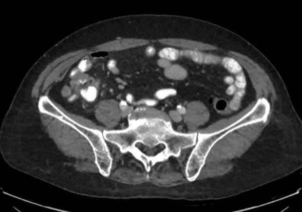 Appendicitis due to chicken fibula (Radiopaedia 74314-85198 A 17).jpg