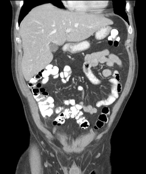 Appendicitis with cecal bar sign (Radiopaedia 31878-32830 A 23).jpg