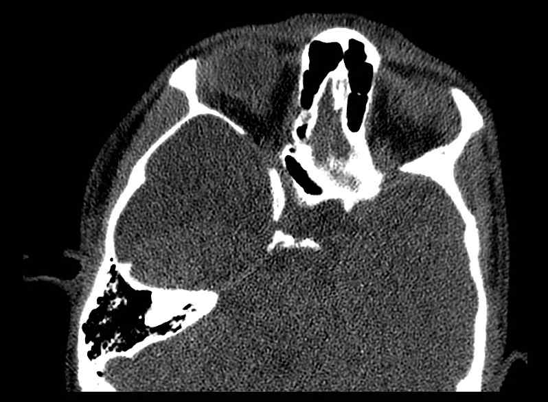 Arachnoid cyst- extremely large (Radiopaedia 68741-78450 Axial bone window 29).jpg