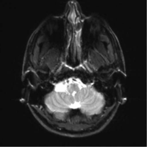 Arachnoid cyst - cerebellopontine angle (Radiopaedia 59689-67083 Axial DWI 5).png