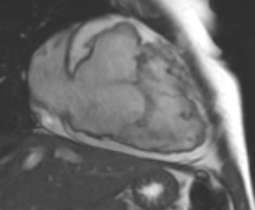 File:Arrhythmogenic right ventricular cardiomyopathy (Radiopaedia 69431-79307 2ch cine 58).jpg