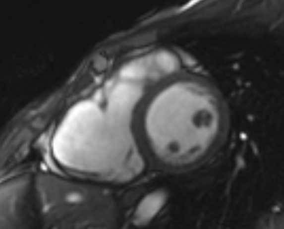 Arrhythmogenic right ventricular cardiomyopathy (Radiopaedia 69564-79464 short axis cine 141).jpg