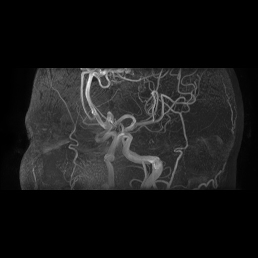 Arteriovenous malformation (Radiopaedia 71628-81999 Axial MRA 6).jpg