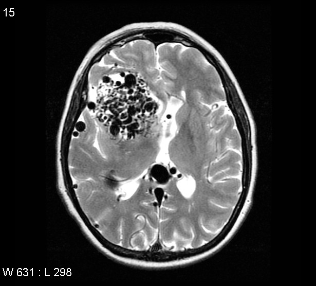 File:Arteriovenous malformation - cerebral (Radiopaedia 4000-6538 Axial T2 9).jpg
