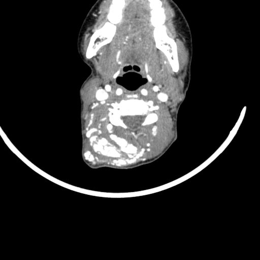 Arteriovenous malformation of the neck (Radiopaedia 53935-60062 A 35).jpg