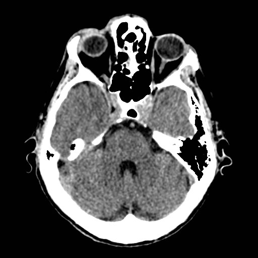 File:Artery of Percheron infarct (Radiopaedia 48088-52893 Axial non-contrast 11).jpg