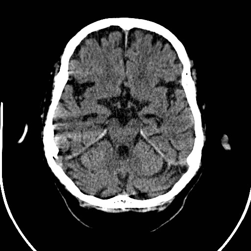 File:Artery of Percheron infarction (Radiopaedia 26307-26438 Axial non-contrast 2).jpg
