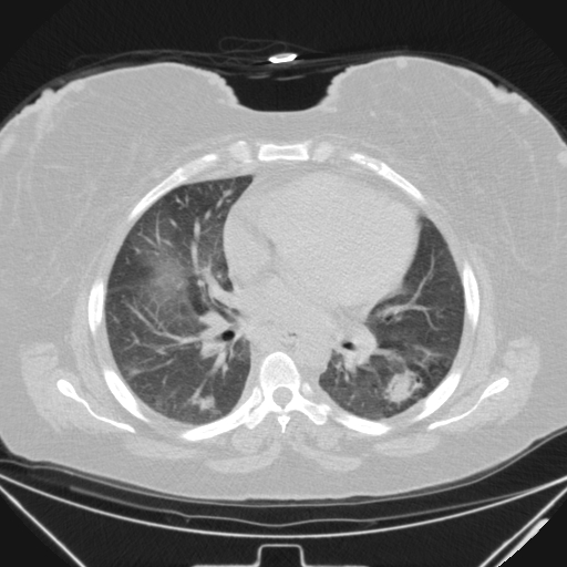 Aspergilloma (Radiopaedia 39611-41932 Axial lung window 69).jpg