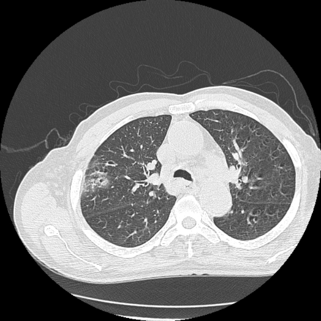 Aspergilloma (Radiopaedia 44592-48327 Axial lung window 28).jpg