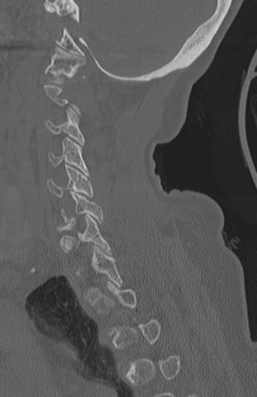 Atlanto-axial subluxation (Radiopaedia 36610-38176 Sagittal bone window 55).png