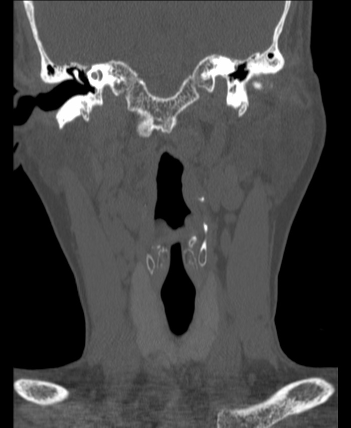 Atlanto-occipital assimilation with basilar invagination (Radiopaedia 70122-80188 Coronal bone window 35).jpg