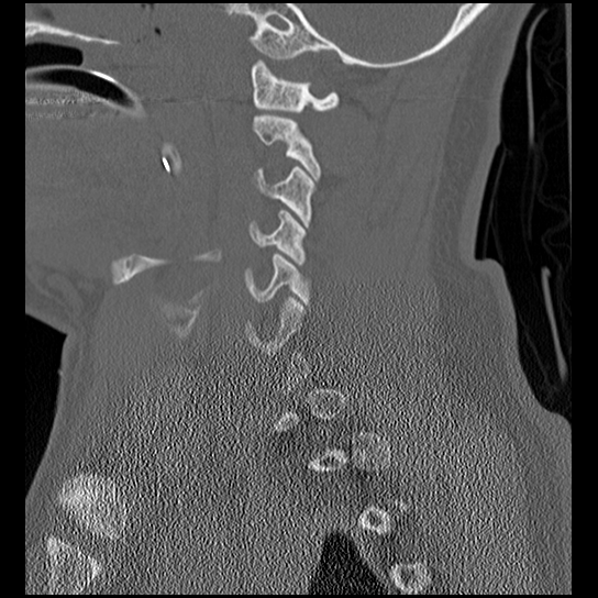 Atlanto-occipital dissociation injury (Radiopaedia 29274-29698 Sagittal bone window 19).png