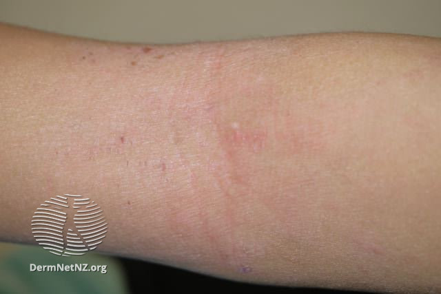File:Atopic dermatitis (DermNet NZ dermatitis-flexural-eczema25).jpg