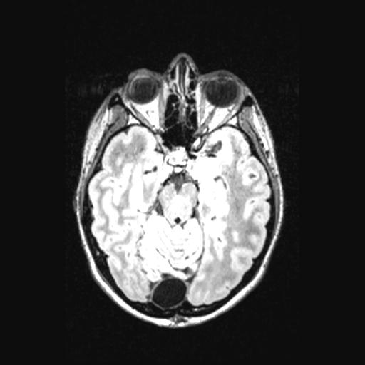 Atretic encephalocoele with inferior vermis hypoplasia (Radiopaedia 30443-31108 Axial 61).jpg
