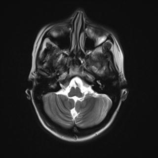 File:Atretic encephalocoele with inferior vermis hypoplasia (Radiopaedia 30443-31108 Axial T2 4).jpg