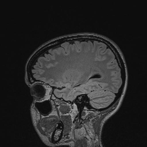Atretic encephalocoele with inferior vermis hypoplasia (Radiopaedia 30443-31108 Sagittal FLAIR 54).jpg