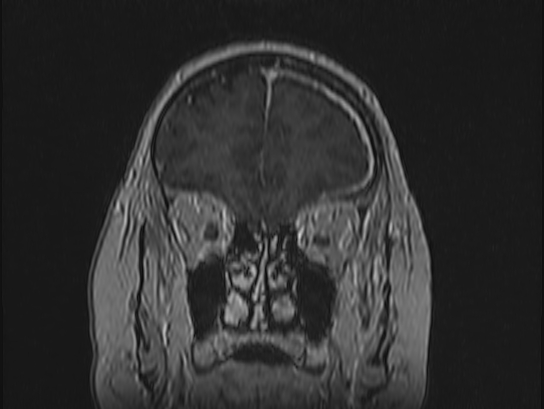 File:Atypical meningioma (Radiopaedia 62985-71406 Coronal T1 C+ 20).jpg