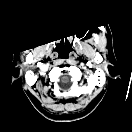 File:Atypical meningioma (WHO grade II) with osseous invasion (Radiopaedia 53654-59715 Axial C+ delayed 6).png
