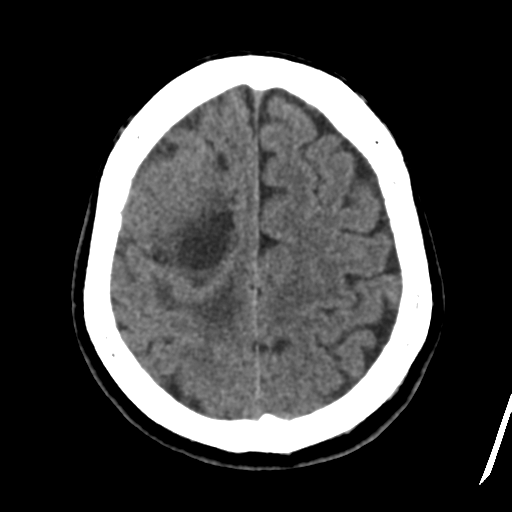 Atypical meningioma (WHO grade II) with osseous invasion (Radiopaedia 53654-59715 Axial non-contrast 41).png
