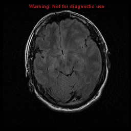 File:Atypical meningioma - grade II (Radiopaedia 13303-13305 Axial FLAIR 9).jpg