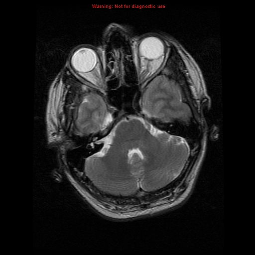 File:Atypical meningioma - grade II (Radiopaedia 13303-13305 Axial T2 6).jpg