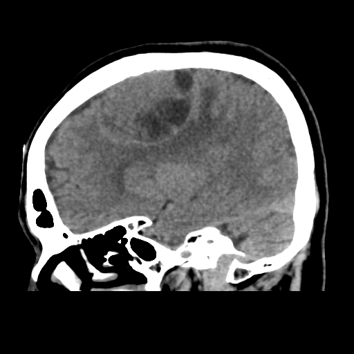 Atypical meningioma with skull invasion (Radiopaedia 34357-35649 E 19).png