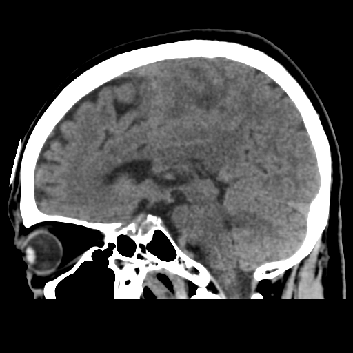 Atypical meningioma with skull invasion (Radiopaedia 34357-35649 E 28).png