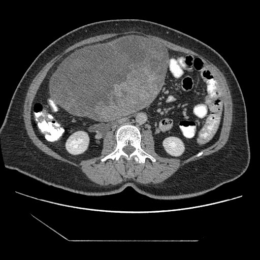 File:Atypical retroperitoneal lymphocoeles with large leiomyoma of uterus (Radiopaedia 32084-33024 A 20).jpg