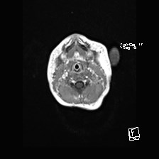 Atypical teratoid rhabdoid tumor (prenatal US and neonatal MRI) (Radiopaedia 59091-66388 Axial T1 C+ 1).jpg